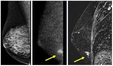 L'usage de l'imagerie 3D permet d'améliorer la détection du cancer du sein — photo 1